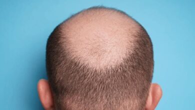 Do you also believe these 3 myths related to genetic hair loss?