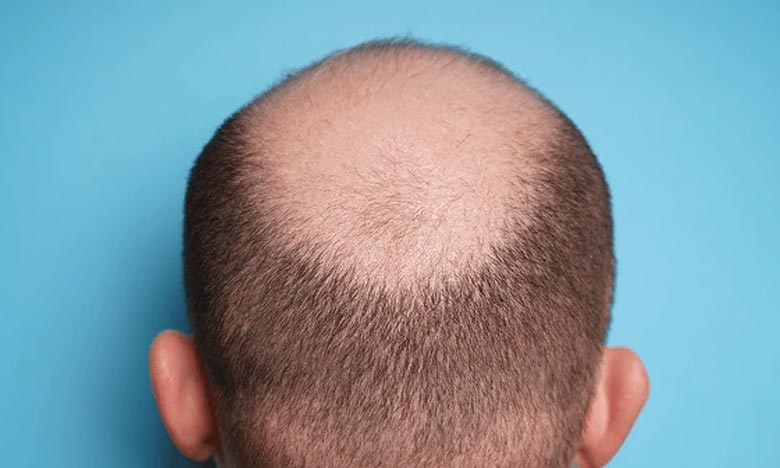 Do you also believe these 3 myths related to genetic hair loss?